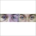 Manufacturers Exporters and Wholesale Suppliers of Blepheroplasty Eyelid Surgery New Delhi Delhi